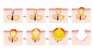 皮脂が過剰に分泌されるとニキビの原因になる